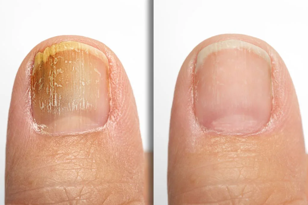 Fungal toenail before and after successful treatment